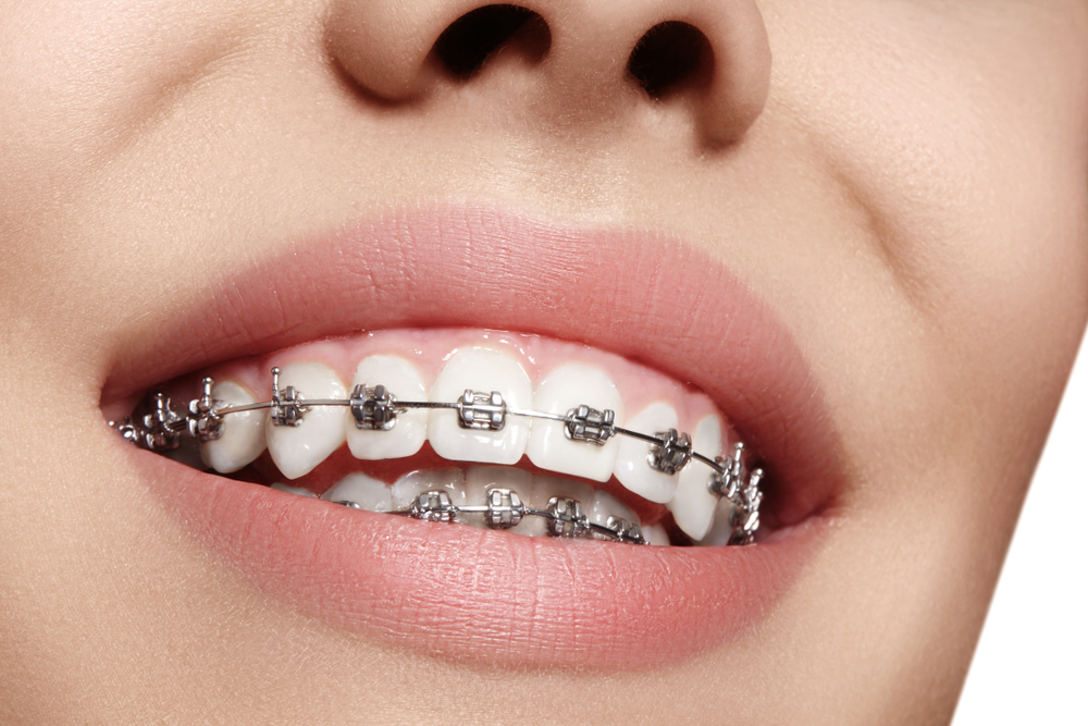 dental braces