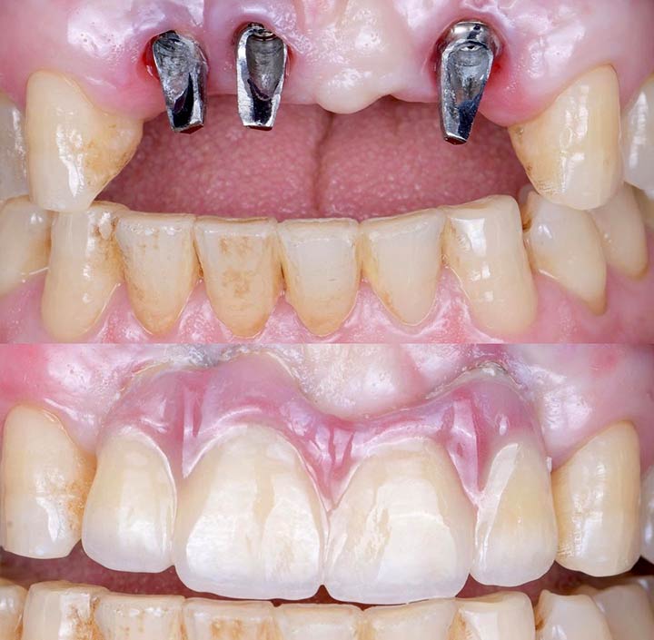 Dental Implants Princeton, TX 75407