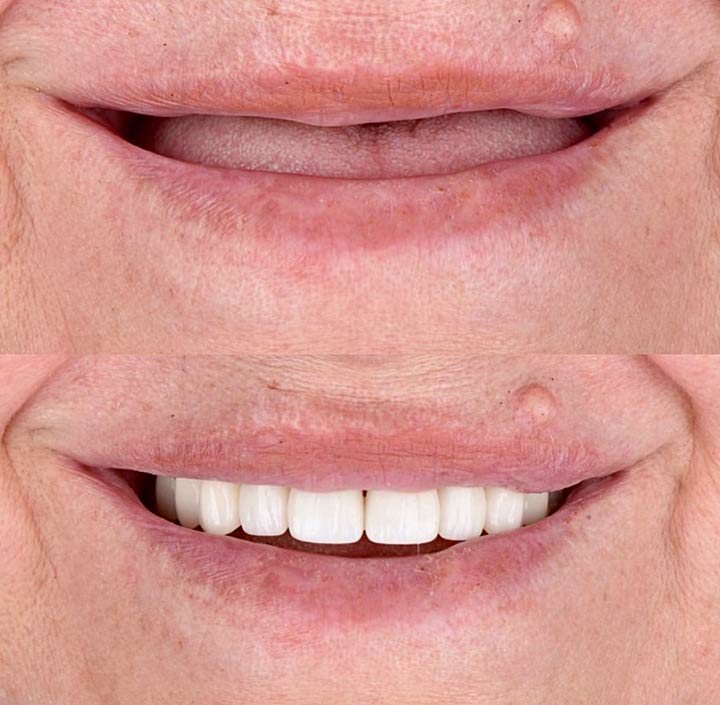 Dental Implants Princeton, TX 75407