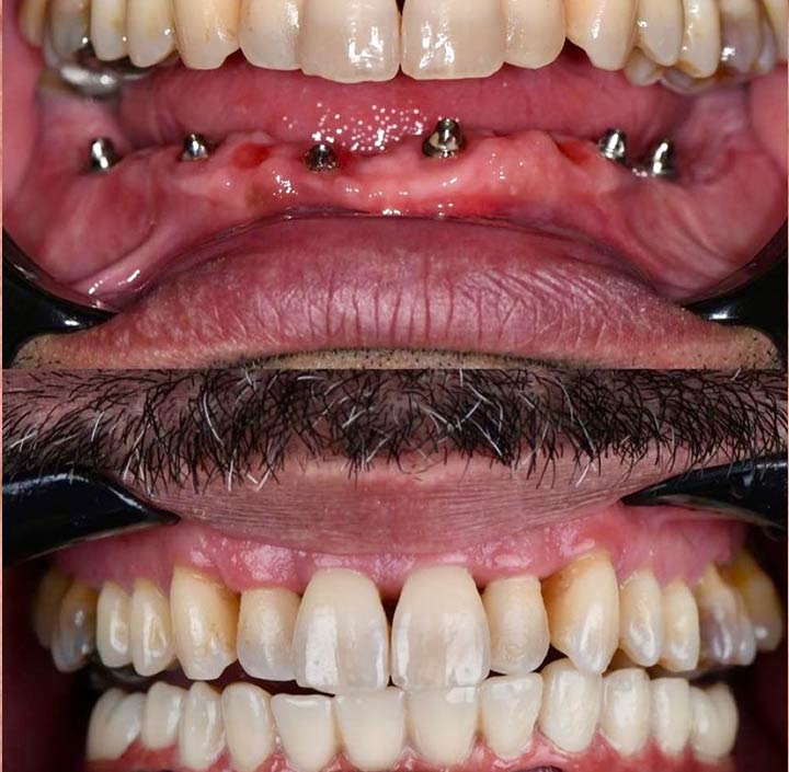 Dental Implants Princeton, TX 75407