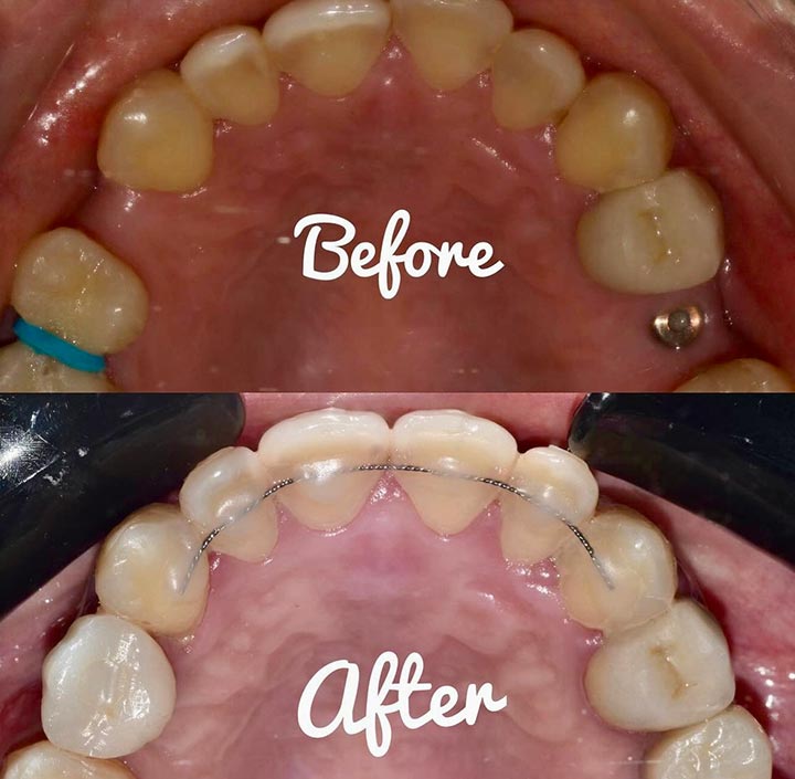 Ortho with Braces Princeton, TX 75407