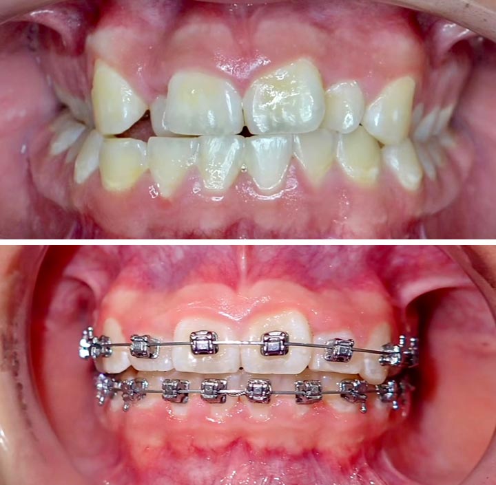 Ortho with Braces Princeton, TX 75407