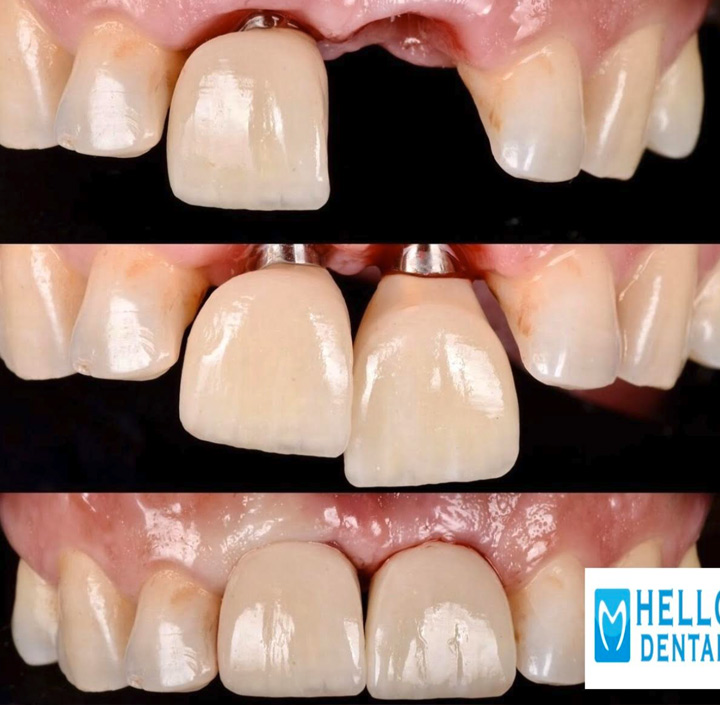 Dental Implants Princeton, TX 75407