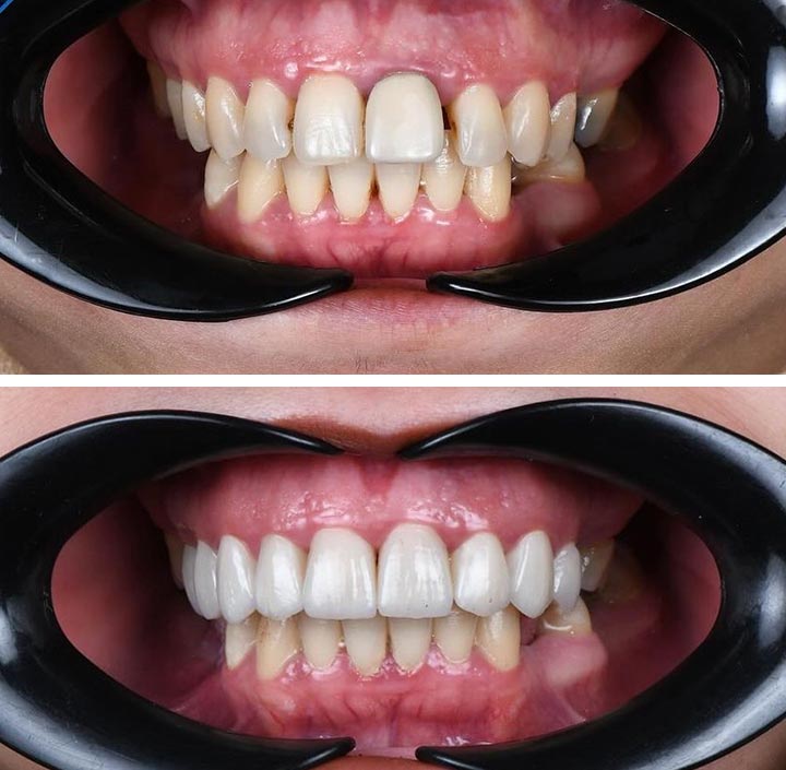 Smile Makeovers Princeton, TX 75407