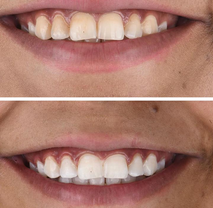 Smile Makeovers Princeton, TX 75407