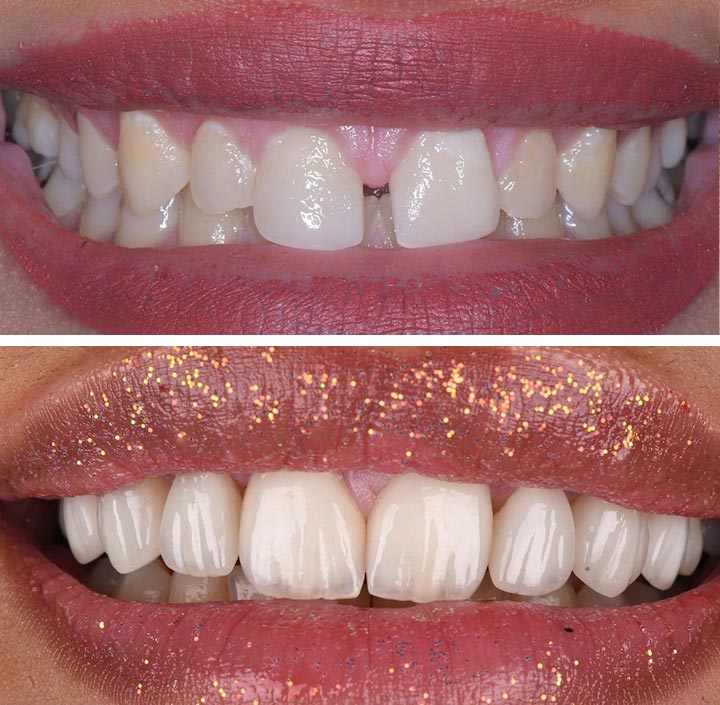 Smile Makeovers Princeton, TX 75407