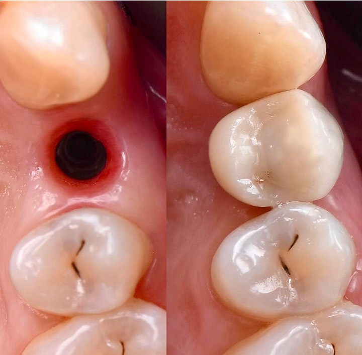 Dental Implants Princeton, TX 75407