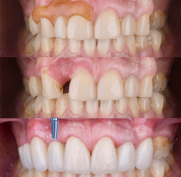 Dental Implants Princeton, TX 75407