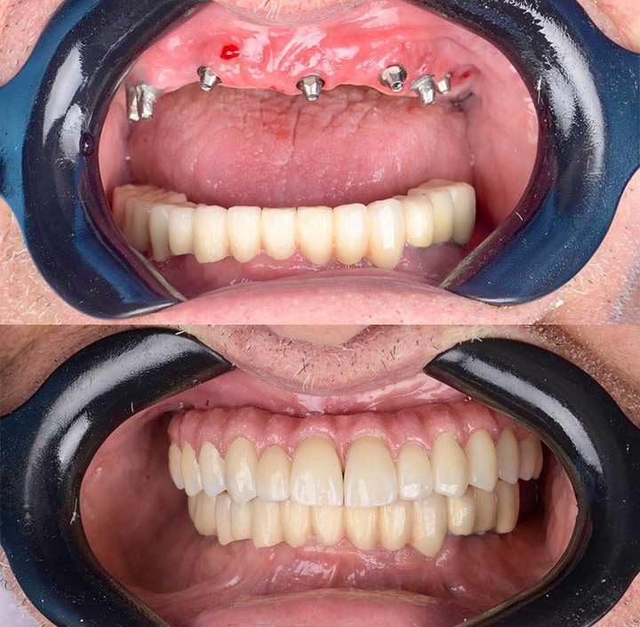 Dental Implants Princeton, TX 75407