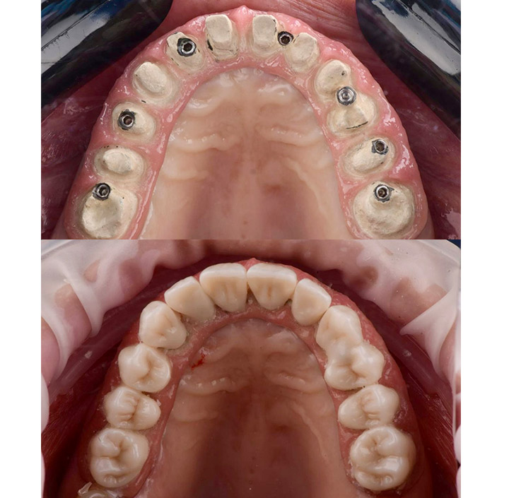 Dental Implants Princeton, TX 75407