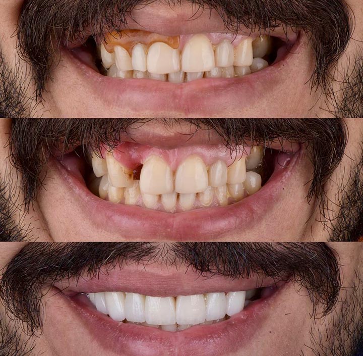 Dental Implants Princeton, TX 75407