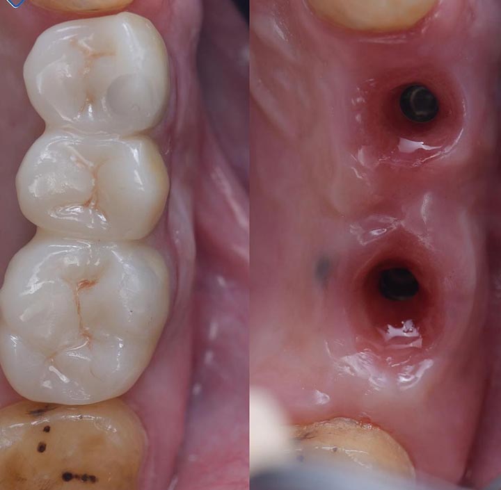Dental Implants Princeton, TX 75407