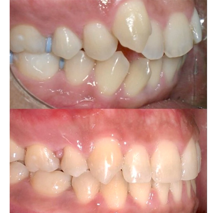 Ortho with Braces Princeton, TX 75407