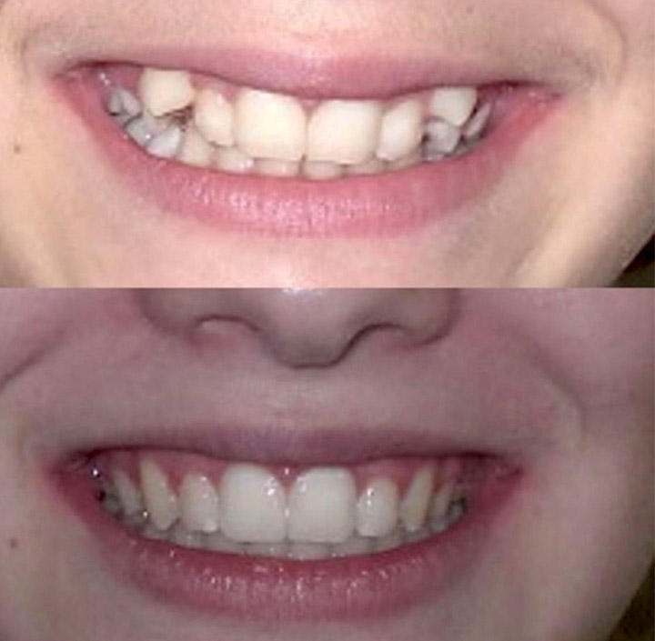 Ortho with Braces Princeton, TX 75407