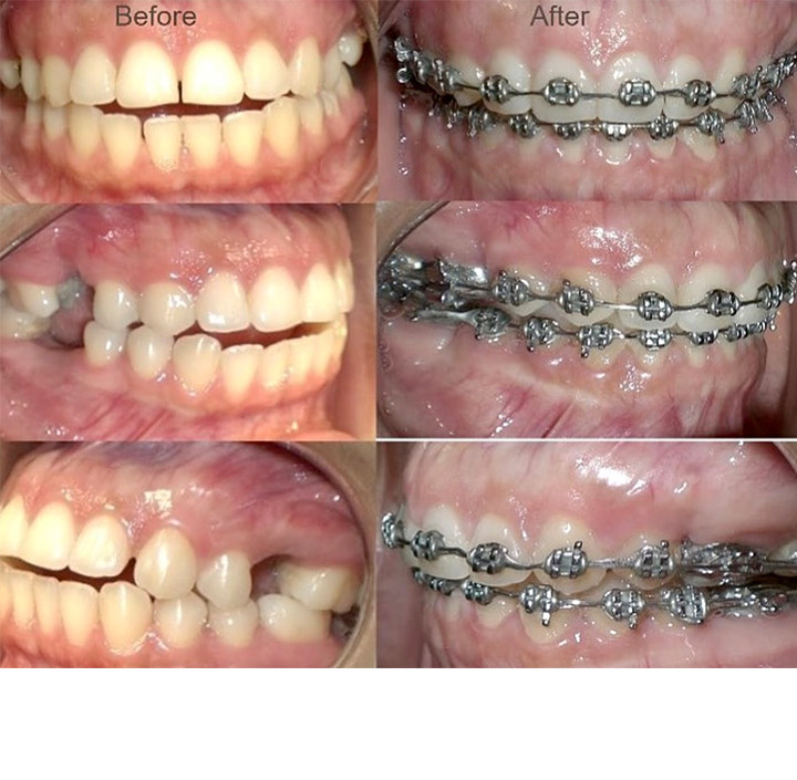 Ortho with Braces Princeton, TX 75407