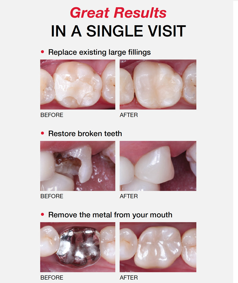 Same Day Dental Crowns Princeton, TX 75407