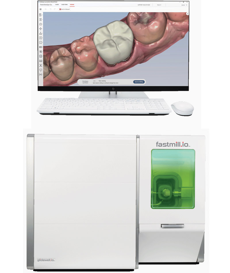 One Day Dental Crowns in Princeton