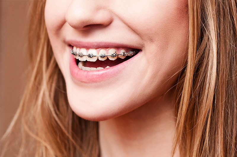 Orthodontics in Princeton