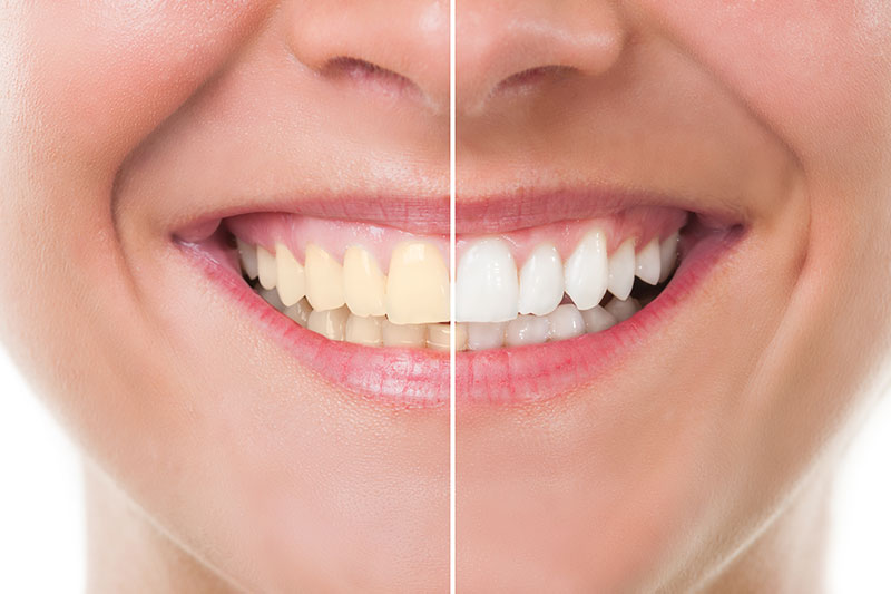 Teeth Whitening in Princeton